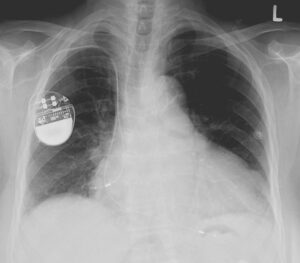 pacemaker image